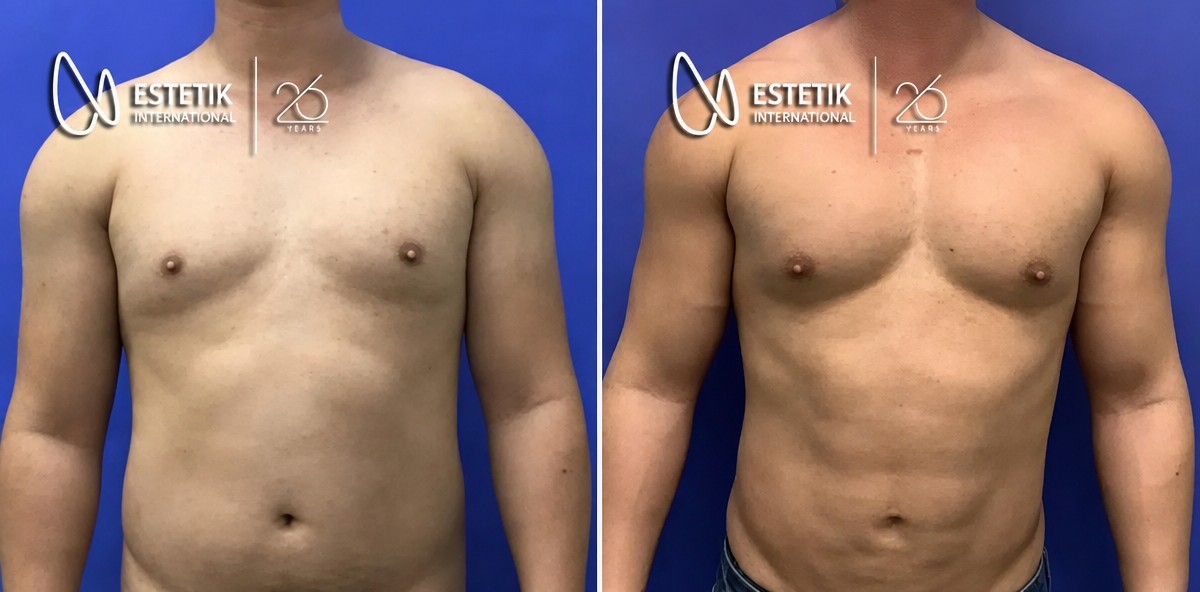 Antes y después de implantes pectorales en Estetik International Istanbul, pecho definido