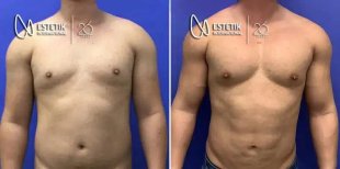 قبل وبعد زرع عضلات الصدر في Estetik International Istanbul، تحسين شكل الصدر