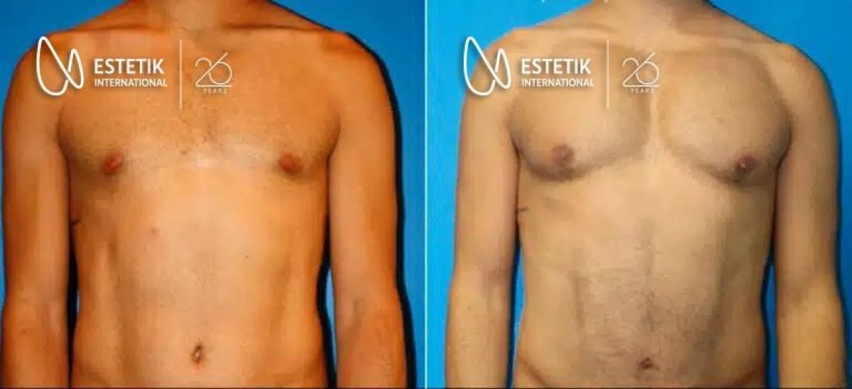 Antes y después de implantes pectorales en Estetik International Istanbul, mejor contorno torácico