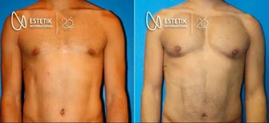قبل وبعد زراعة عضلات الصدر في Estetik International Istanbul، تحسين شكل الصدر
