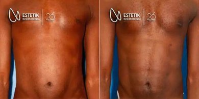 نتيجة قبل وبعد زراعة عضلات الصدر في Estetik International Istanbul وتحسين شكل الصدر