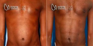 نتيجة قبل وبعد زراعة عضلات الصدر في Estetik International Istanbul وتحسين شكل الصدر