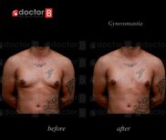 Vorher-nachher-Ergebnis Gynäkomastie-OP bei Estetik International Istanbul, männliche Brustform