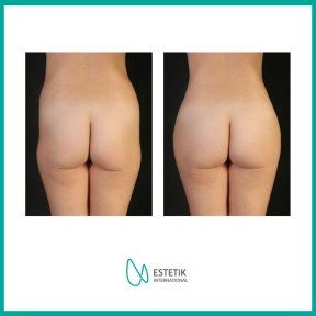 Vorher-nachher-Ergebnis Gesäßimplantate bei Estetik International Istanbul – verbesserte Form