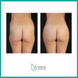 Vorher-nachher-Ergebnis Gesäßimplantate bei Estetik International Istanbul – verbesserte Form
