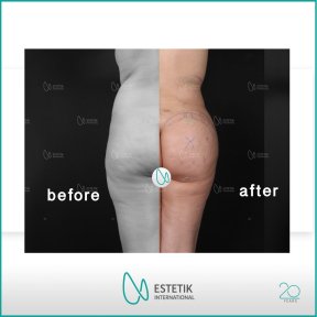 Vorher-nachher-Ergebnisse von Gesäßimplantaten bei Estetik International Istanbul, verbesserte Form