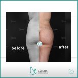 Vorher-nachher-Ergebnisse von Gesäßimplantaten bei Estetik International Istanbul, verbesserte Form