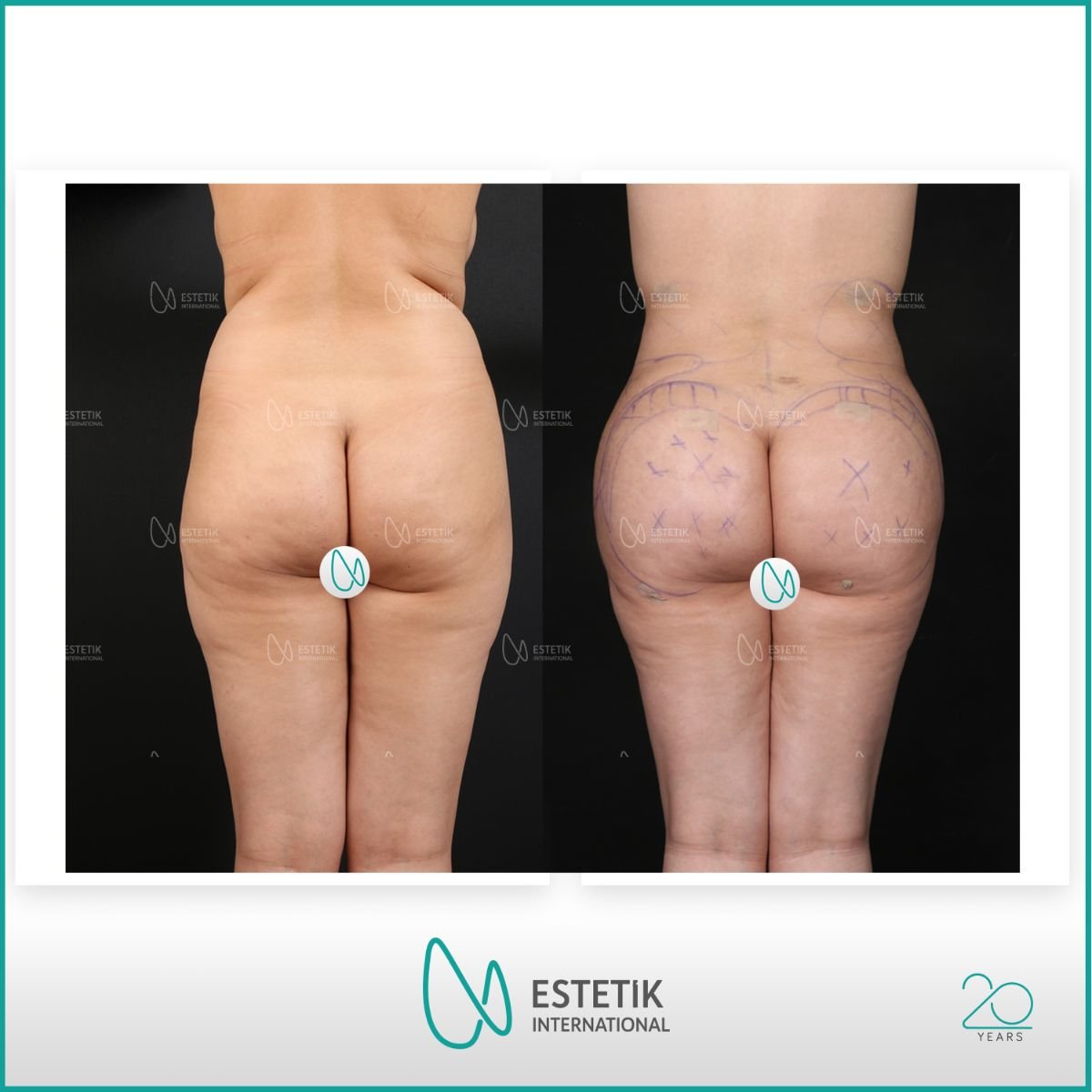 نتيجة قبل وبعد زراعة المؤخرة في Estetik International Istanbul، تحسين شكل الأرداف