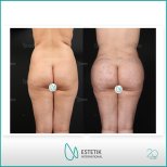 Vorher-nachher-Ergebnis Gesäßimplantate bei Estetik International Istanbul, verbesserte Kontur