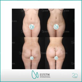Vorher-nachher-Ergebnis Po-Implantate bei Estetik International Istanbul, verbesserte Konturen