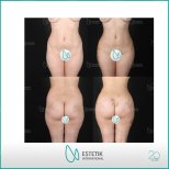Vorher-nachher-Ergebnis Po-Implantate bei Estetik International Istanbul, verbesserte Konturen