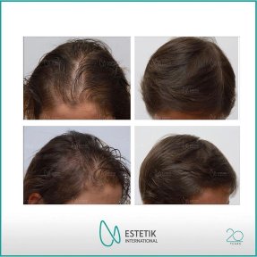 Vorher-nachher-Ergebnisse FUE-Haartransplantation bei Estetik International Istanbul, vollere Haarlinie