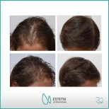 Vorher-nachher-Ergebnisse FUE-Haartransplantation bei Estetik International Istanbul, vollere Haarlinie