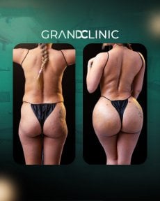 Before and after Brazilian Butt Lift results at Grand Clinic – enhanced buttock contour