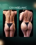 Before and after Brazilian Butt Lift results at Grand Clinic – enhanced buttock contour