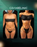 Resultados de liposucción antes y después en Grand Clinic, mejora visible del contorno corporal