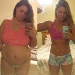 Before and after endoscopic sleeve gastroplasty at Memorial Ataşehir Hospital, weight loss result