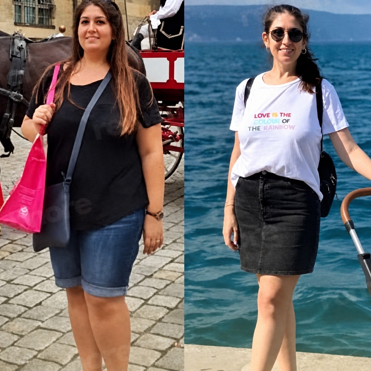 Resultados antes y después de gastroplastia endoscópica en Memorial Ataşehir Hospital