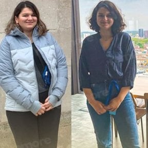 Before and after endoscopic sleeve gastroplasty results at Memorial Ataşehir Hospital