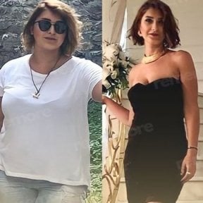 Before and after endoscopic sleeve gastroplasty results at Memorial Ataşehir Hospital