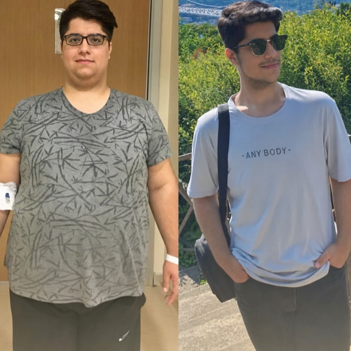 Resultados antes y después de gastroplastia endoscópica en Memorial Ataşehir Hospital