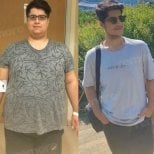 Before and after endoscopic sleeve gastroplasty results at Memorial Ataşehir Hospital