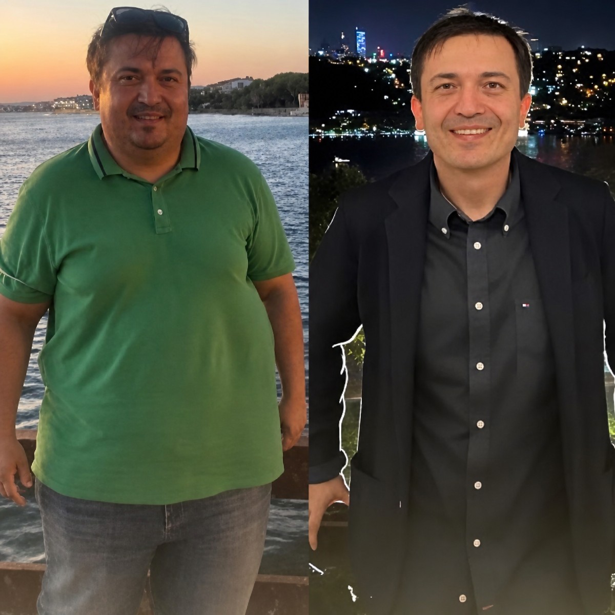 قبل وبعد تكميم المعدة بالمنظار في مستشفى ميموريال أتاشهير، نتيجة فقدان الوزن