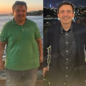 Before and after endoscopic sleeve gastroplasty at Memorial Ataşehir Hospital, weight loss result