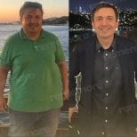 Before and after endoscopic sleeve gastroplasty at Memorial Ataşehir Hospital, weight loss result