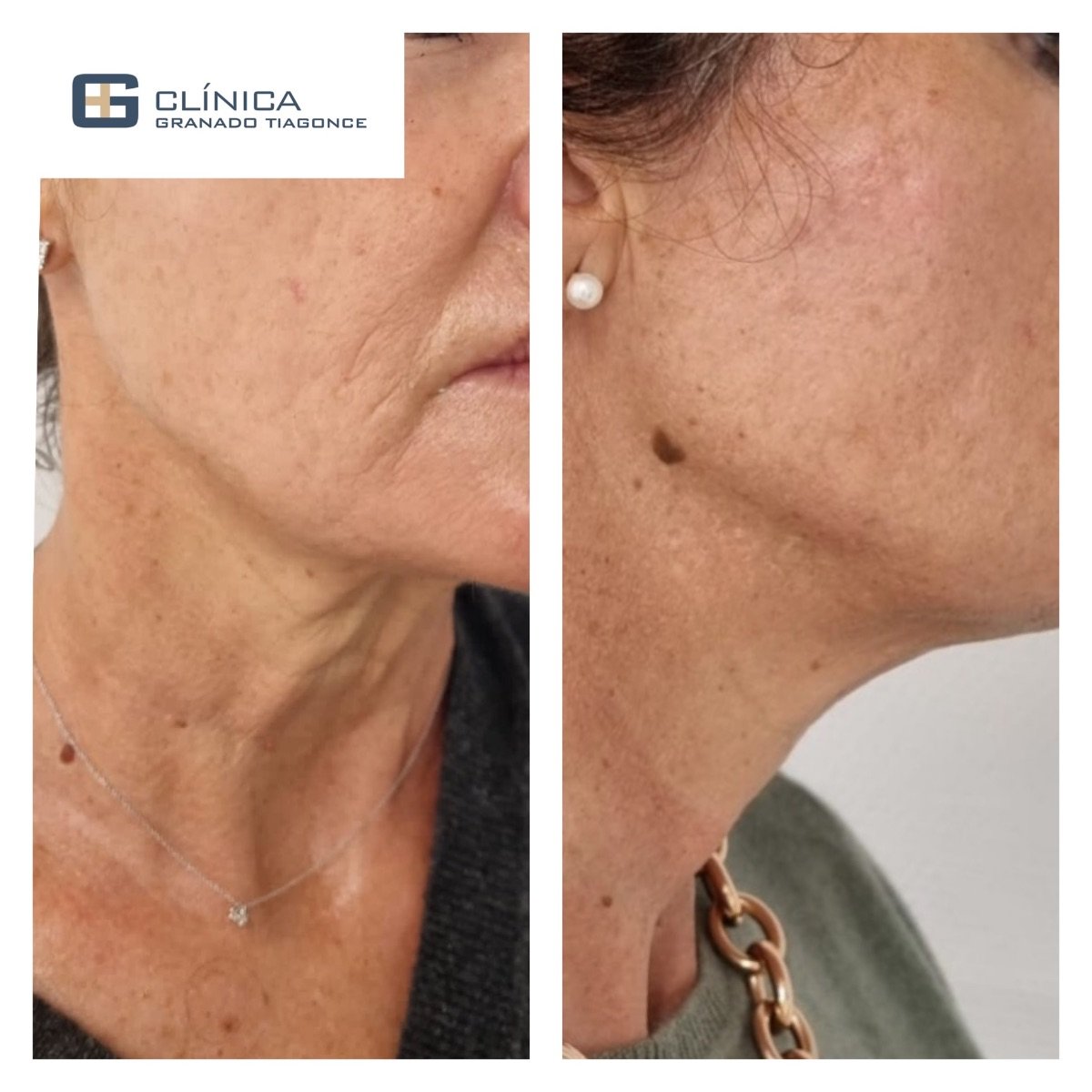 Resultados de lifting de cuello antes y después en Clinica Granado Tiagonce, piel más firme