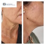 Before and after neck lift results at Clinica Granado Tiagonce, visible skin tightening effect