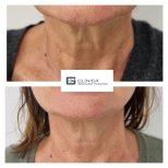Before and after neck lift results at Clinica Granado Tiagonce, visible neck tightening