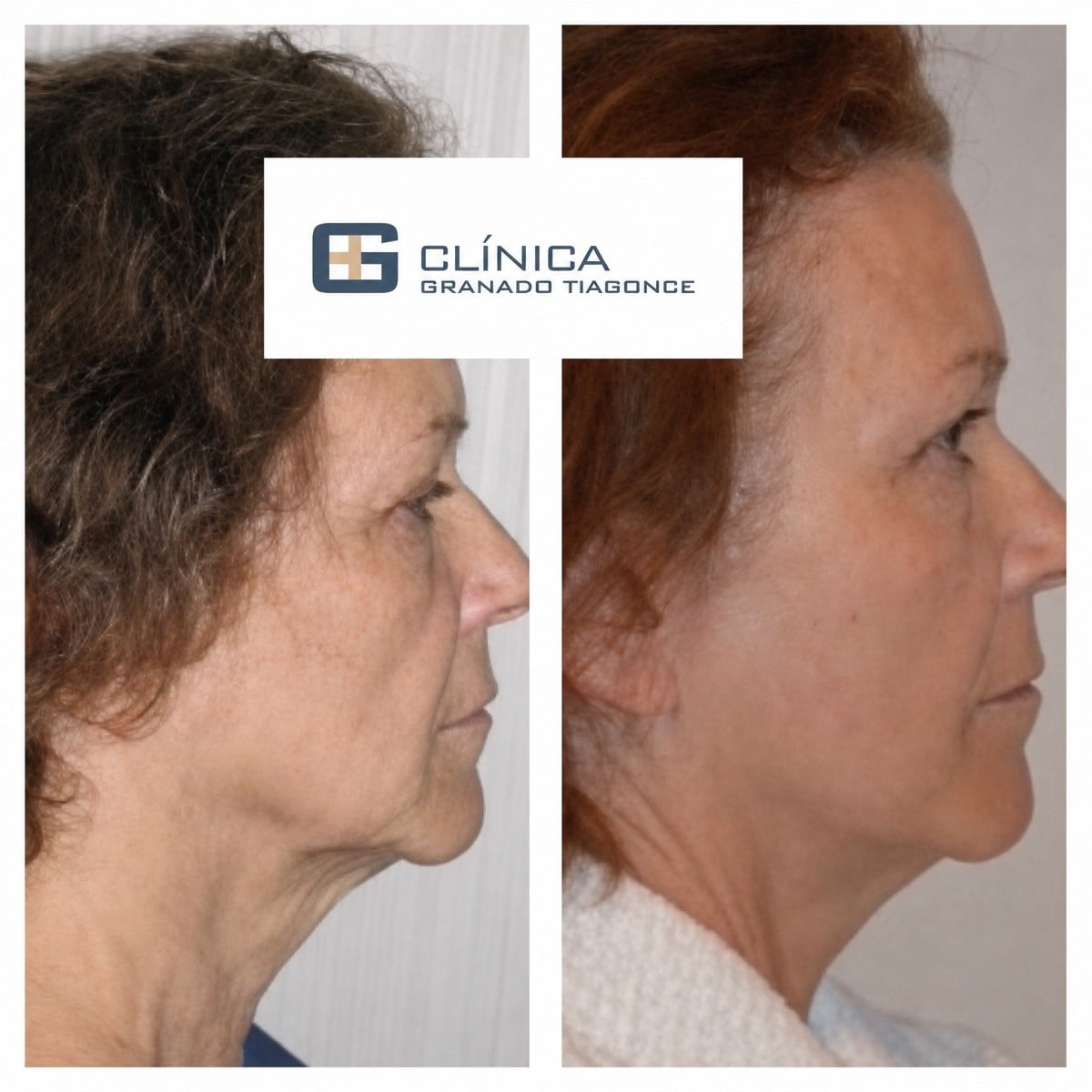 Resultados de lifting de cuello antes y después en Clinica Granado Tiagonce, cuello más firme