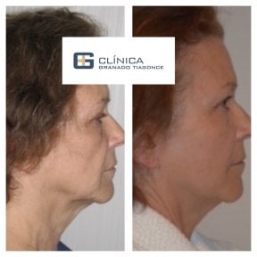 Before and after neck lift results at Clinica Granado Tiagonce, visible neck tightening