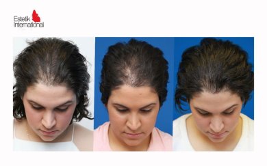 FUE-Haartransplantation Vorher-Nachher-Ergebnisse bei Estetik International Istanbul, dichteres Haar