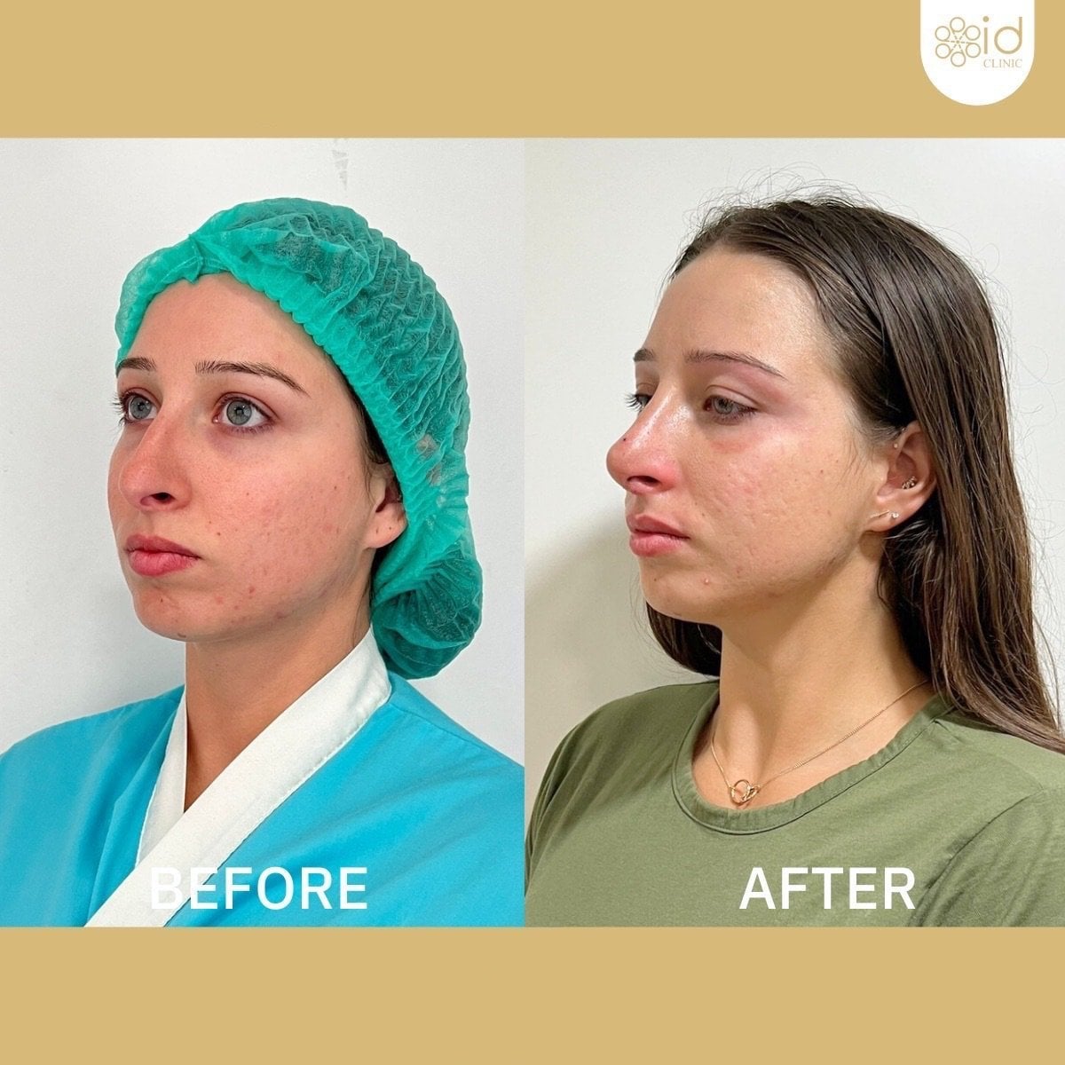 Resultado antes y después de rinoplastia ultrasónica en ID Clinic Bangkok, remodelación nasal