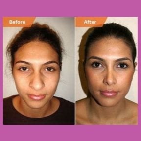 Before and after ultrasonic rhinoplasty result at ID Clinic Bangkok, refined nose shape