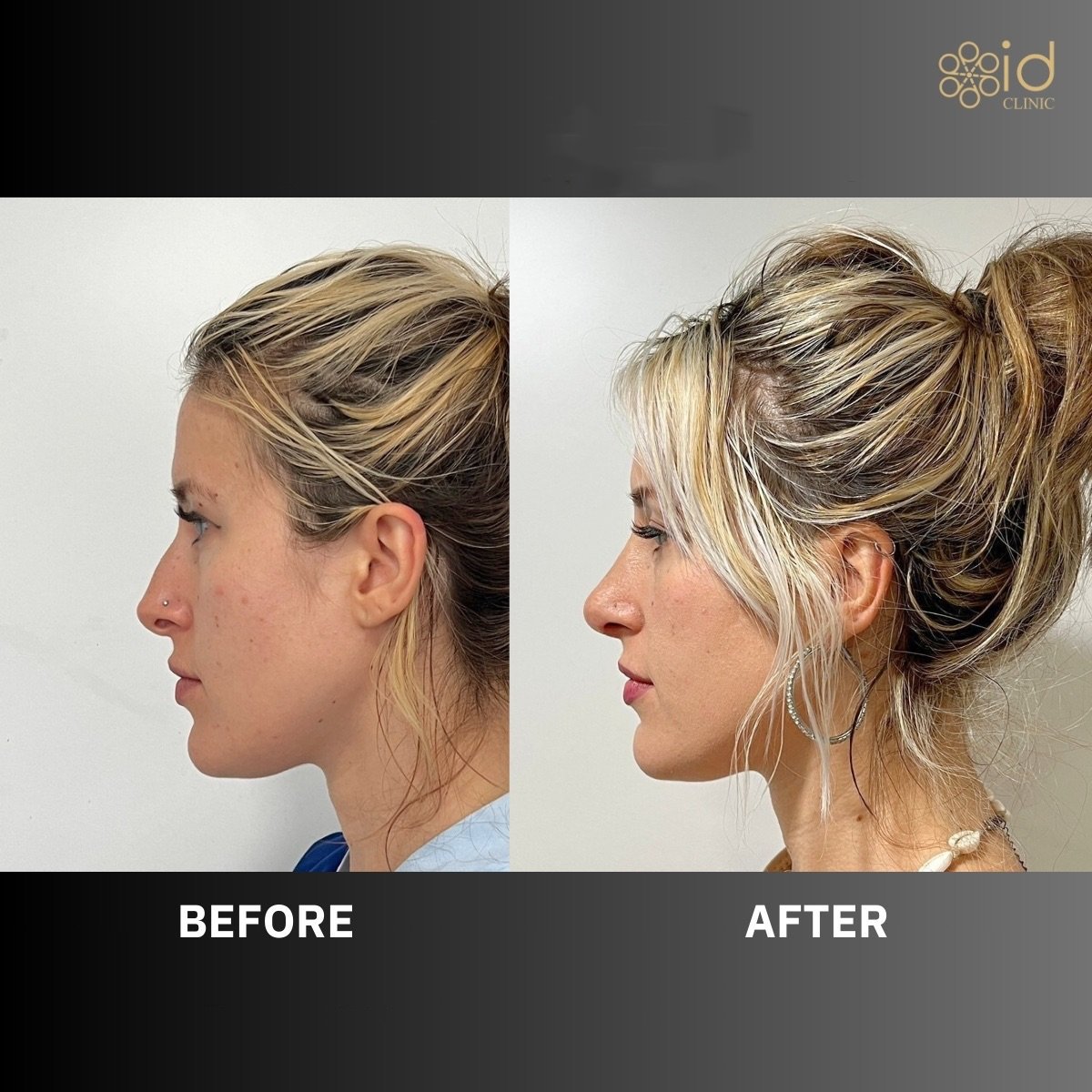 Resultado antes y después de rinoplastia ultrasónica en ID Clinic Bangkok, remodelación nasal