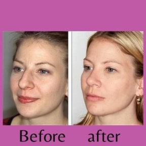 Before and after ultrasonic rhinoplasty results at ID Clinic Bangkok, refined nose shape