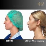 Before and after ultrasonic rhinoplasty result at ID Clinic Bangkok, 14 days post-surgery