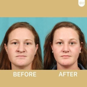 Before and after ultrasonic rhinoplasty results at ID Clinic Bangkok, nose reshaping visible