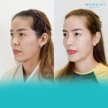 Результати ліпофілінгу обличчя до і після у Wansiri Hospital, покращений об’єм