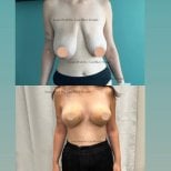 Before and after breast lift results at Memorial Bahçelievler Hospital, improved breast contour