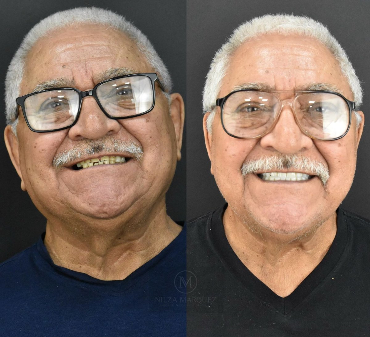Resultados antes y después de coronas de zirconia en DDS Nilza Márquez Dental Practice
