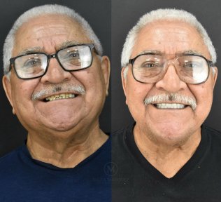 Vorher-nachher-Ergebnis Zirkonkrone bei DDS Nilza Márquez Dental Practice