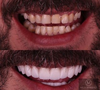 Vorher-nachher-Ergebnis Veneers bei DDS Nilza Márquez Dental Practice, Lächeln-Transformation