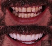 Vorher-nachher-Ergebnis Veneers bei DDS Nilza Márquez Dental Practice, Lächeln-Transformation
