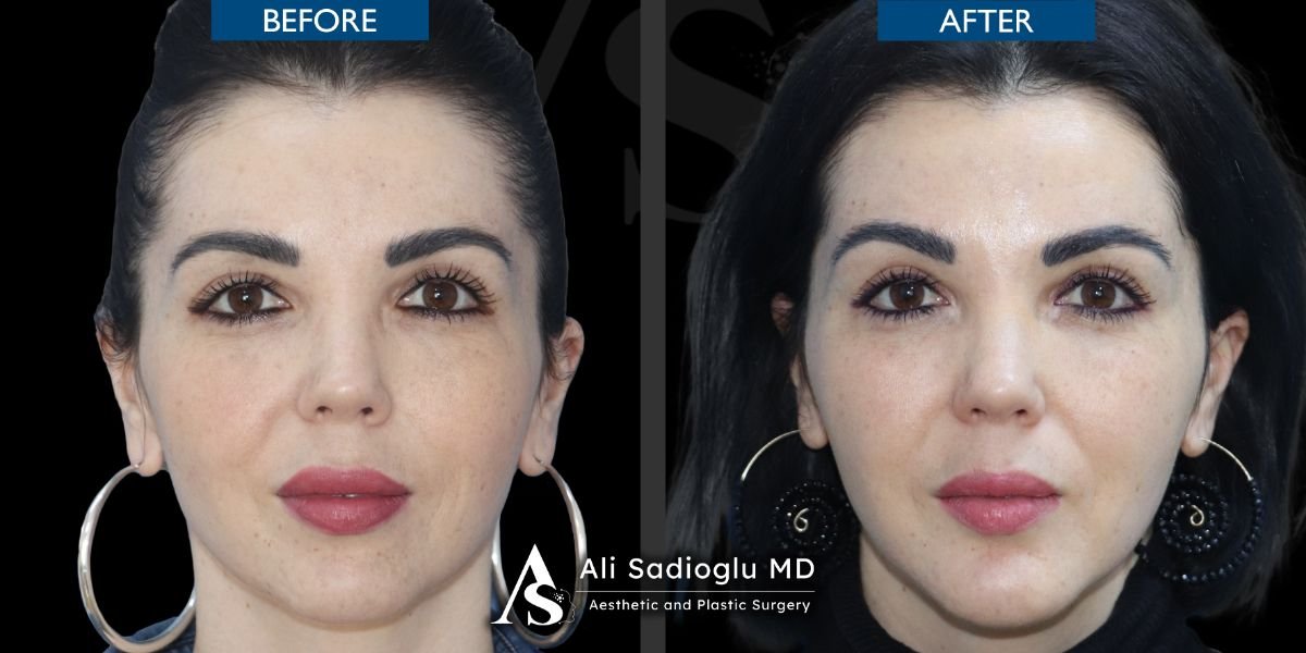 نتائج قبل وبعد زراعة الذقن في عيادة Dr. Safa Manav، تحسين شكل الذقن