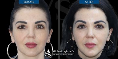 Before and after chin implant results at Dr. Safa Manav Clinic, enhanced chin contour