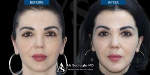 Before and after chin implant results at Dr. Safa Manav Clinic, enhanced chin contour